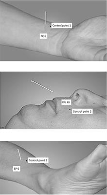 Somatosensory Stimulation With XNKQ Acupuncture Modulates Functional Connectivity of Motor Areas